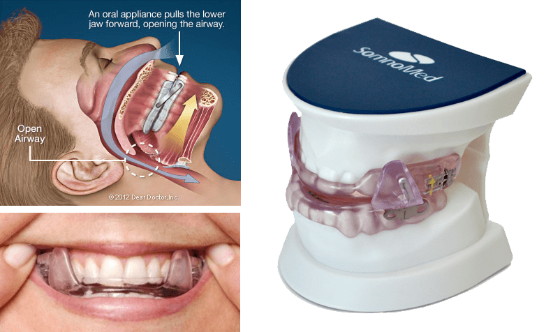 Sleep Apnea Oral Appliance